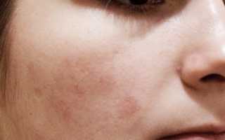 Как проявляется диатез у взрослых? Полное руководство