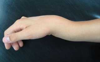 Перелом руки со смещением