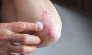 Почему чешутся руки до локтя? Узнайте причины и решения