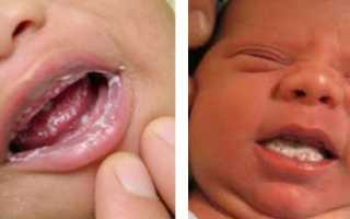 Почему возникает молочница у грудничка во рту? Причины и советы