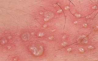 Сыпь и пятна на теле на нервной почве: причины и лечение