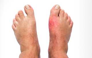 Подагра на ноге