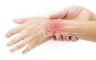 Артрит лучезапястного сустава