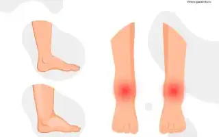 Аллергический артрит