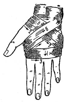 Восьмиобразная (крестообразная) повязка на кисть