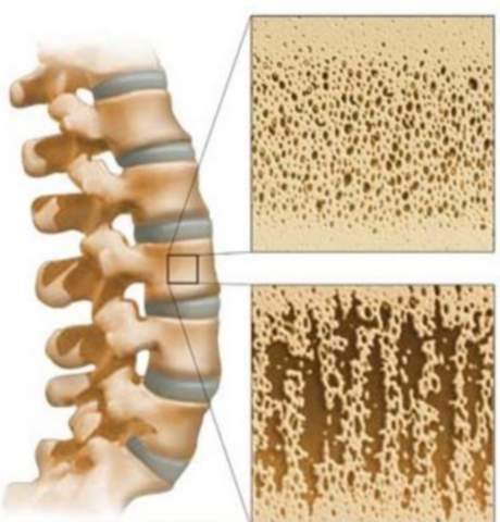 Лечение остеопороза народными средствами