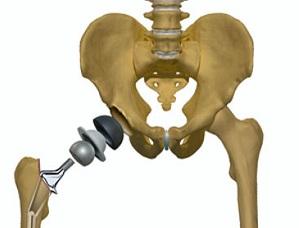 Остеопороз тазобедренного сустава