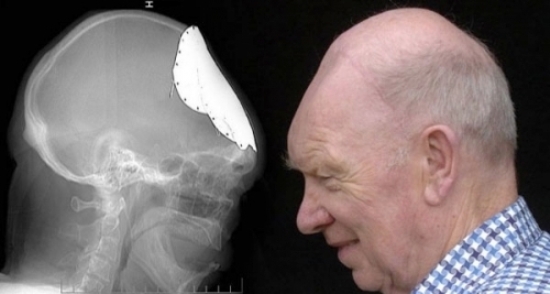 мужчина-с-пластиной-в-черепе