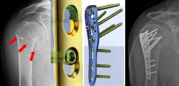 osteosintez-plechevoy-kosti
