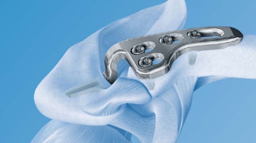 пластина-в-плече