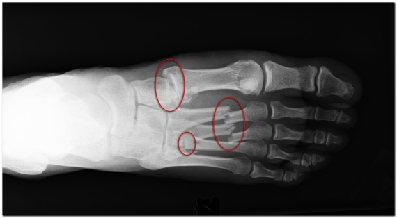 рентген-переломов-плюсневых-костей