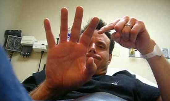 у-мужчины-перелом-пальца