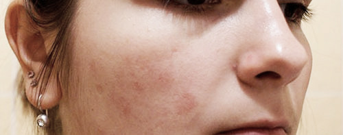 Аллергический диатез у взрослых