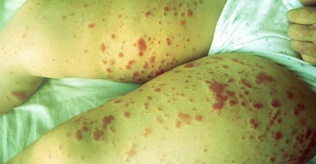 Геморрагический диатез