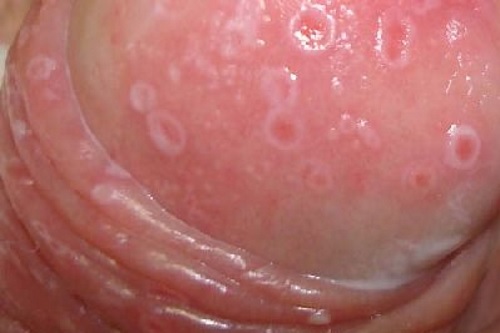 При молочнице пенис высыпает пятнами